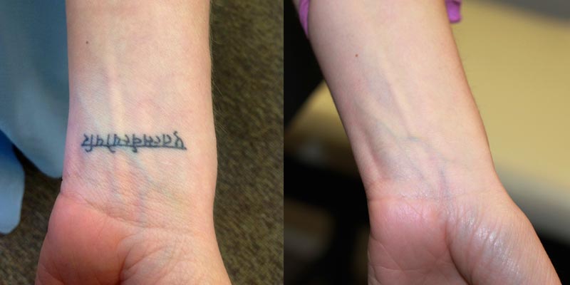 Tattoo Removal Results  Before and After Pictures