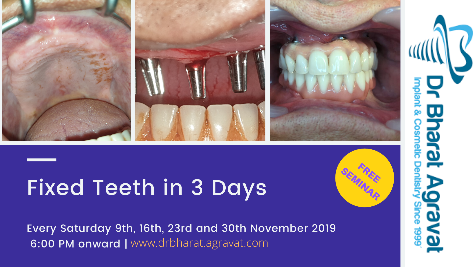 Permanent Fixed New Teeth in 3 Days by Dental Implants in Ahmedabad Gujarat India, Ahmedabad, Gujarat, India