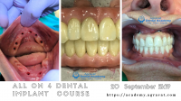 All on 4/6 Dental Implant Training Course, Hands On, Live Surgery in Ahmedabad Gujarat India