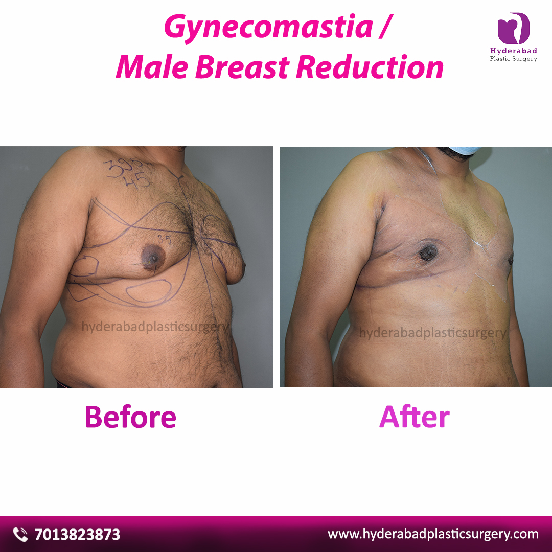 Best Gynecomastia Surgery in Hyderabad, Online Event