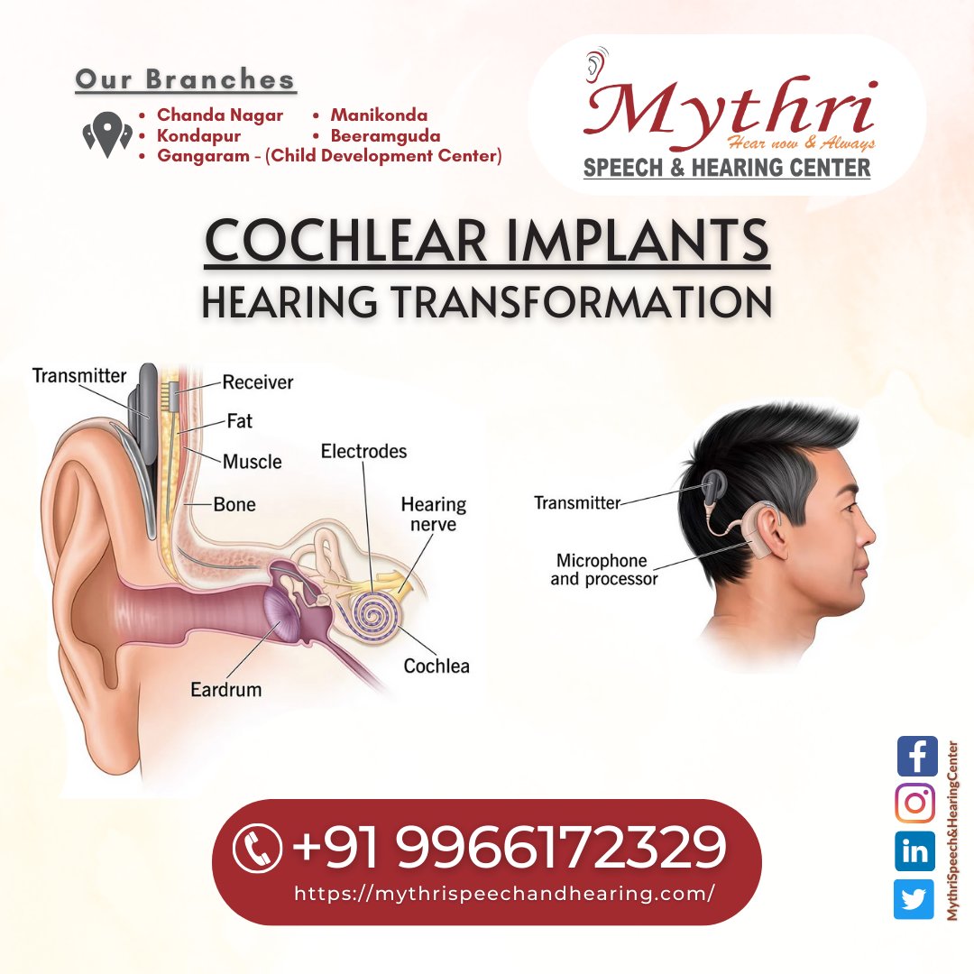 Cochlear Implants | Cochlear Implants Assessment | Cochlear Implant Surgery in Hyderabad | Top Cochlear Implant Rehabilitation Centres in Hyderabad, Hyderabad, Telangana, India