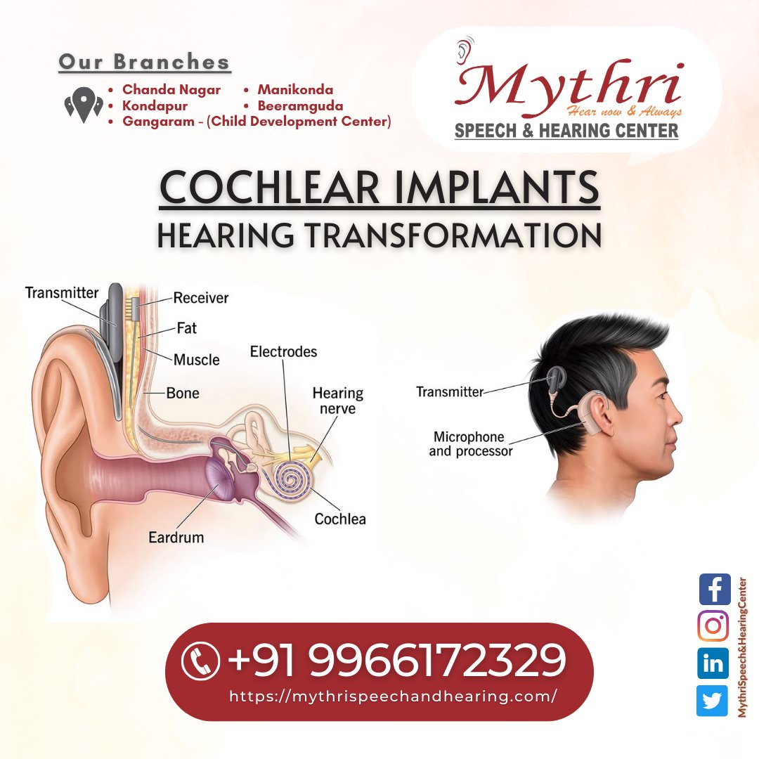 Cochlear Implants | Cochlear Implants Assessment | Cochlear Implant Surgery in Hyderabad, Hyderabad, Telangana, India