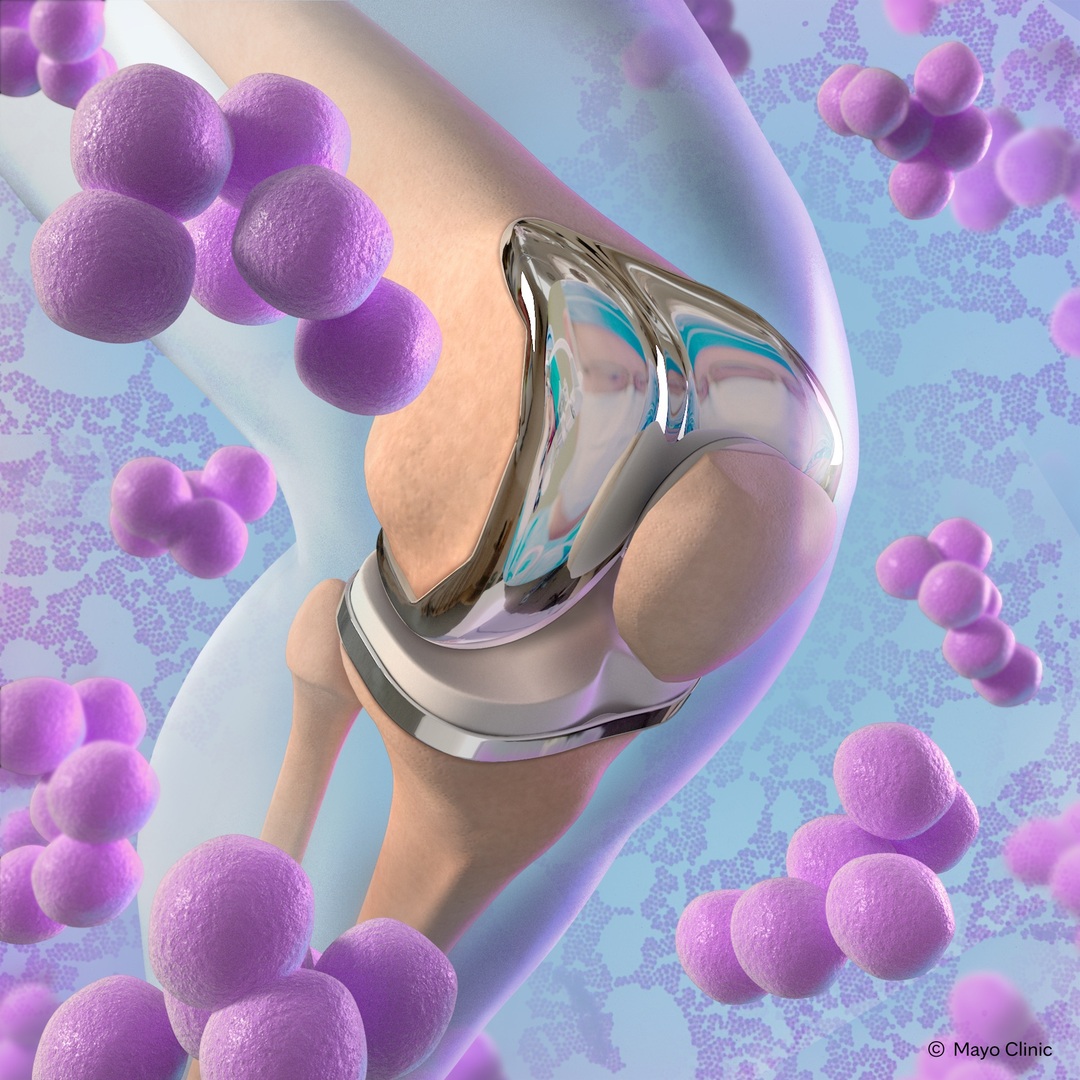 Orthopedic Infectious Diseases 2025, Rochester, Minnesota, United States