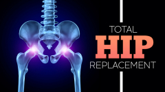 Total Hip Replacement | Post Hip And Knee Replacement Care Services | Total Knee Replacement